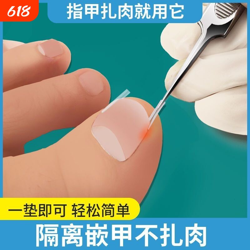 甲沟矫正器脚趾甲专用指甲修正器嵌甲长肉里正甲扣甲纠正器神器炎