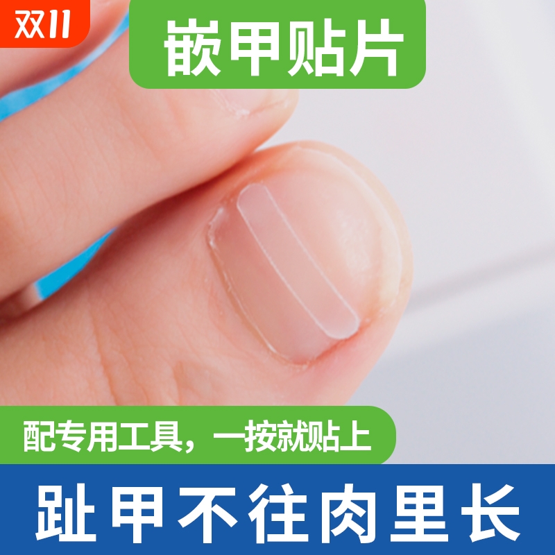 正甲贴夹沟脚指甲长肉里正甲贴片甲沟嵌甲趾甲神器炎矫正器