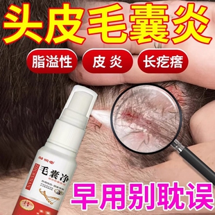 头癣藓顽固毛囊炎脂溢性皮焱疙瘩头皮屑杀菌止痒去屑顽固专用喷剂