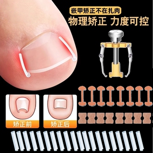 甲沟矫正器嵌甲贴片炎防脚指甲往肉里长专用工具隔离垫片神器趾甲