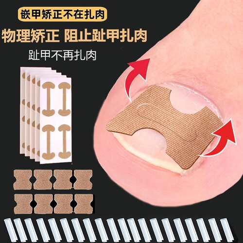甲沟嵌甲矫正器贴片脚趾甲往肉里长脚指甲专用隔离垫片矫正神器