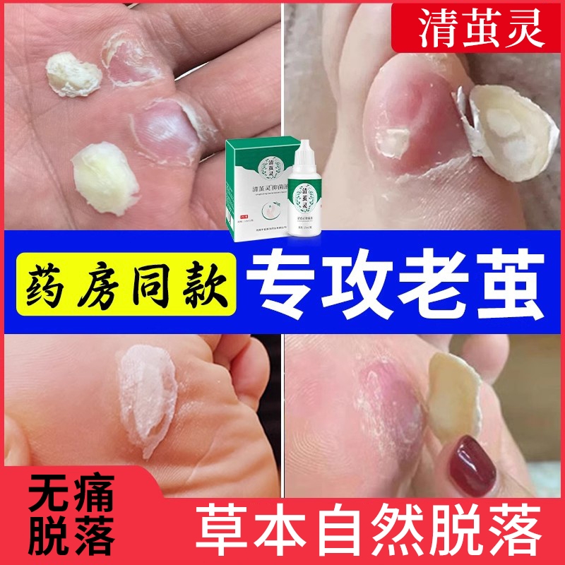 专攻老茧鸡茧【无痛脱落】软化剂