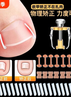 甲沟矫正器嵌甲贴片炎防脚指甲往肉里长专用工具隔离垫片神器趾甲