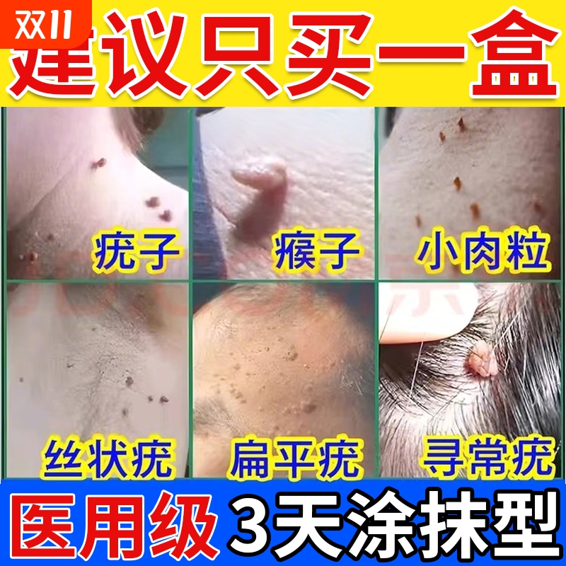 克疣膏去除疣瘊肉粒【热销No.I】