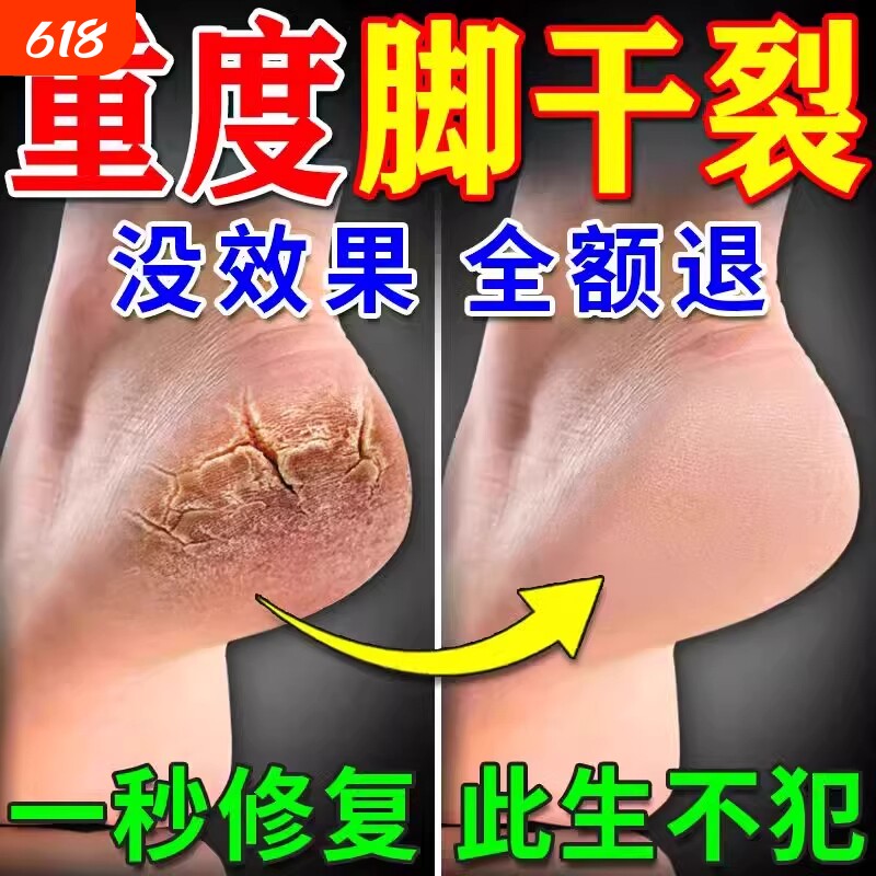 脚后跟干裂修复霜手足龟裂开裂皲裂治起皮去死皮润马油皱裂膏