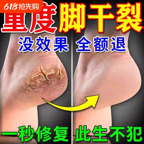 脚后跟干裂修复霜手足龟裂开裂皲裂治起皮去死皮润马油皱裂膏