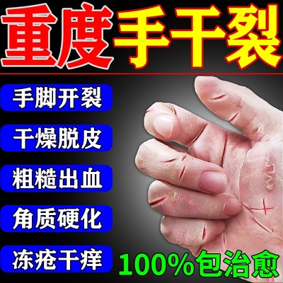 治手裂的药手裂口修复护手霜脚后跟干裂起硬皮足跟开裂药专用J