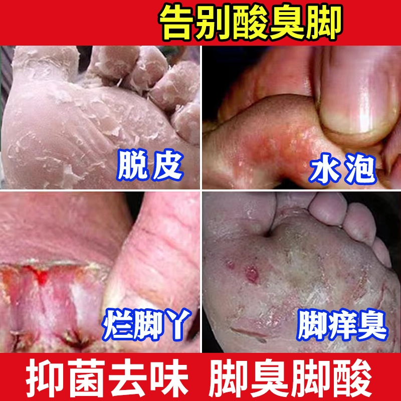 除异味洗脚液除臭杀菌去脚气脚臭