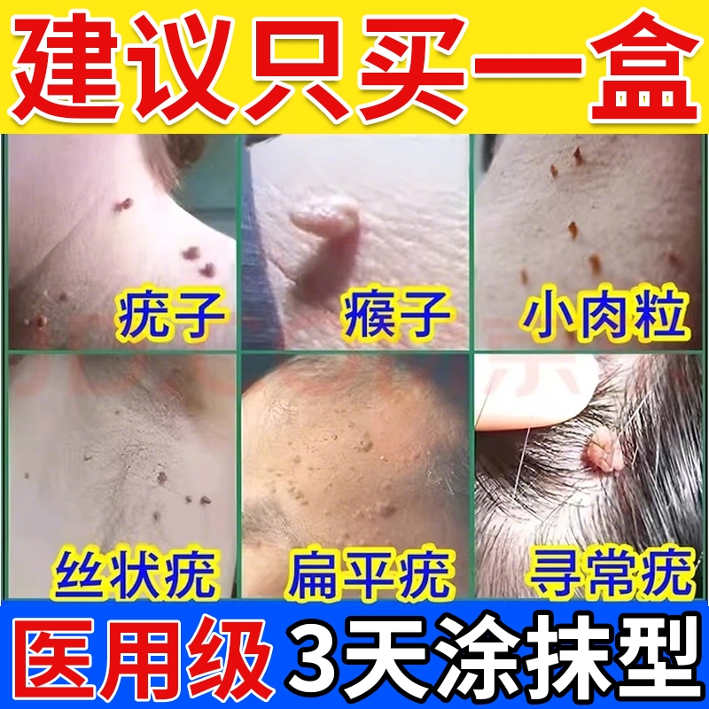 克疣膏去除疣瘊肉粒【热销No.I】