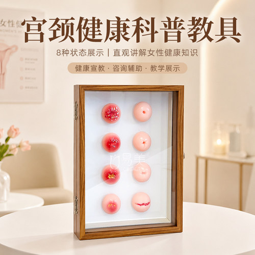女性宫颈健康8种状态科普模型