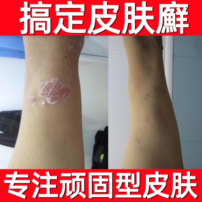 鹅掌风铜钱藓牛皮癣断根特效止痒鲜药膏真菌大苗方药膏治疗牛皮癣