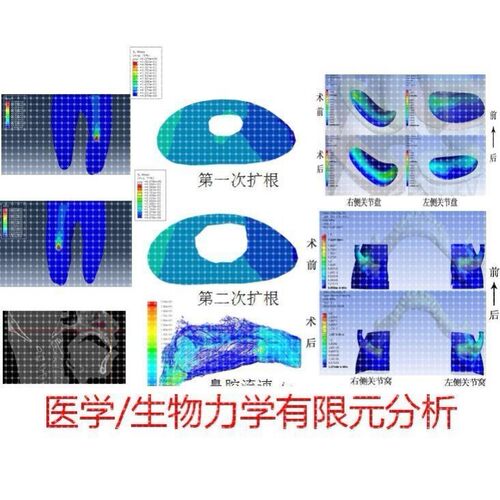 代做/ANSYS/Abaqus/Marc/生物医学工程&生物力学有限元分析