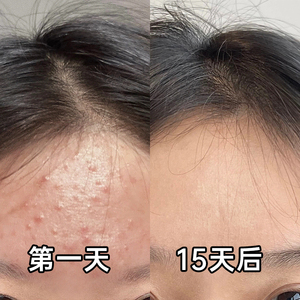 【小红书推荐 挑战七天脸上无豆】净颜壬二酸洗面奶 跟豆豆说拜拜