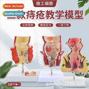 Hemorrhoidal lesion model anal intestinal pathology hemorrho