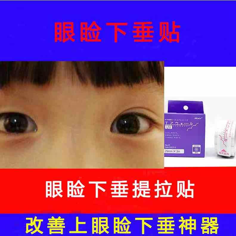 小孩上眼睑下垂提拉贴矫正贴胶布矫正胶带儿童上睑下垂悬吊纠正