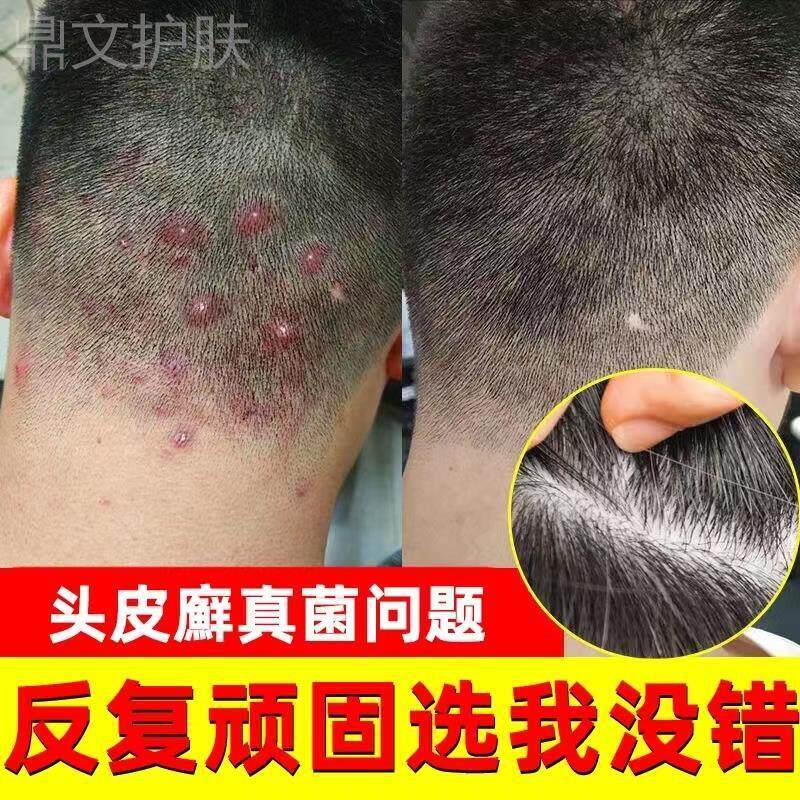 治头皮癣的药去屑皮肤抑菌软膏克星囊毛炎正品杀菌长痘痘头上专用