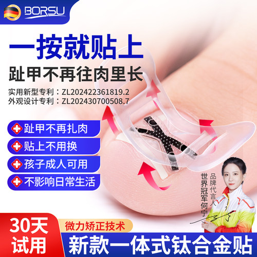 ->【易拉环专利】钛合金嵌甲矫正
