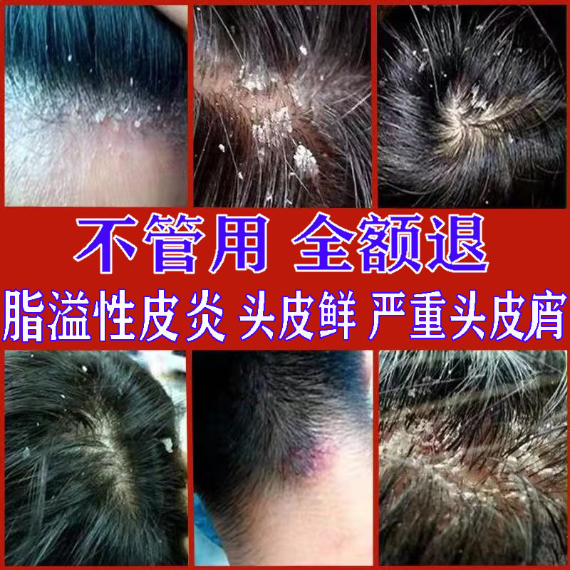 （包冶好）头皮藓脂溢性皮炎膏