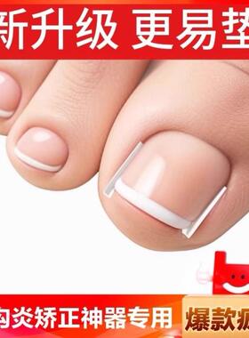 甲沟炎水晶矫正离嵌甲神器专用隔垫片填充脚趾头往肉里长正甲贴C
