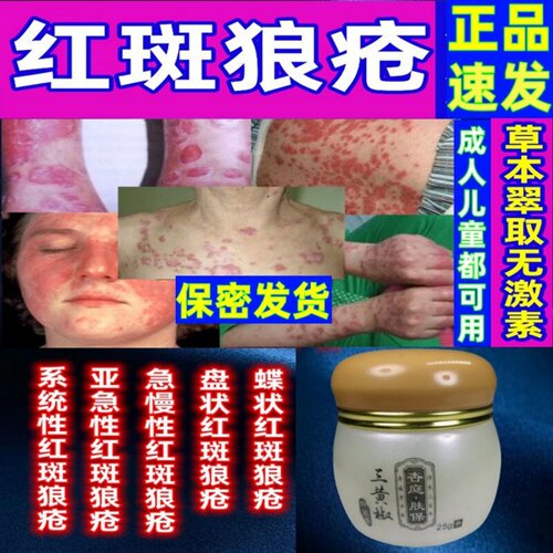 治系统性红斑狼疮外用药亚急性皮肤型急慢性蝶状盘状红斑狼疮克星