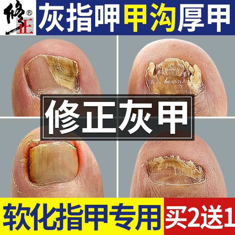 修正灰指甲专用液脱甲膏去旗舰店正品除增厚抑菌非治疗藥冰醋酸