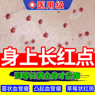 樱桃状血管瘤血管痣点红痣凝胶痣点痣无痕正品去除手臂上小红点膏