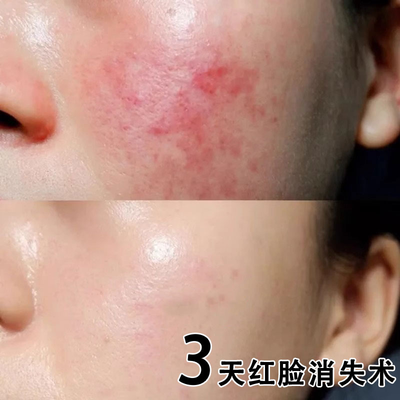 面膜补水保湿角质层泛红去红血丝