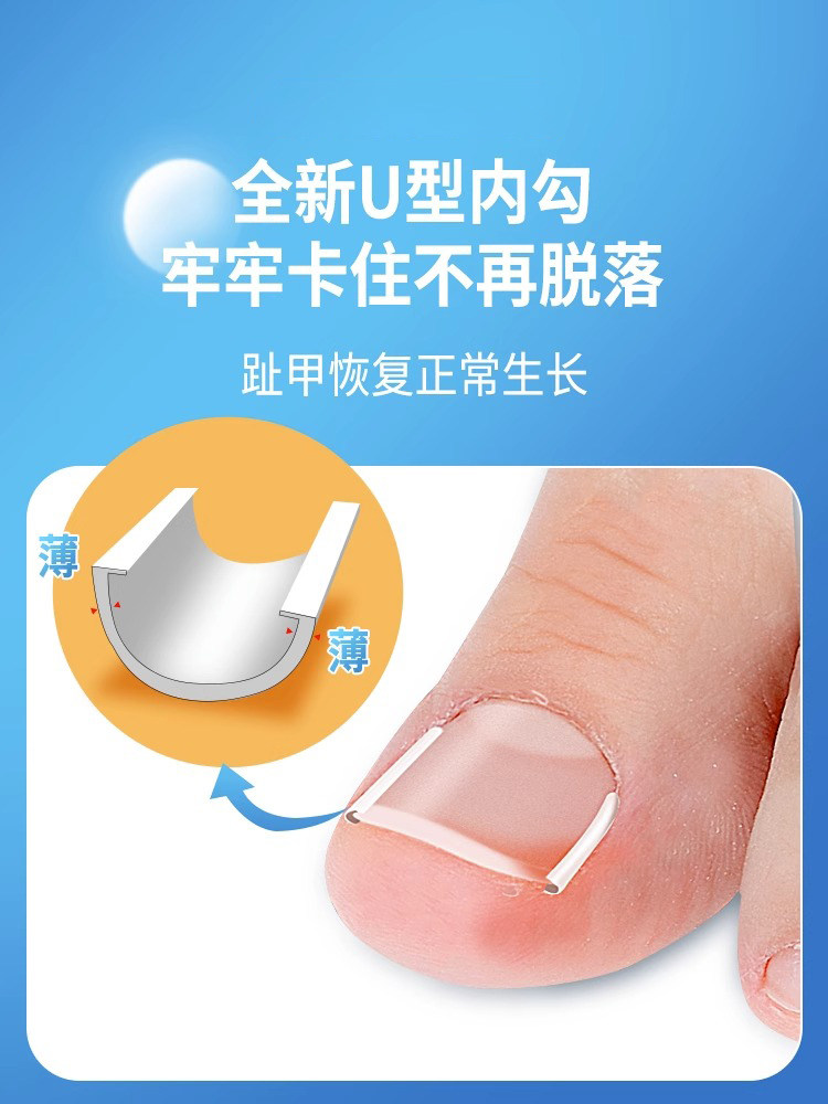 손톱 홈용 발톱 교정기 내생발톱 특수 격리 패드 발톱 교정 패치