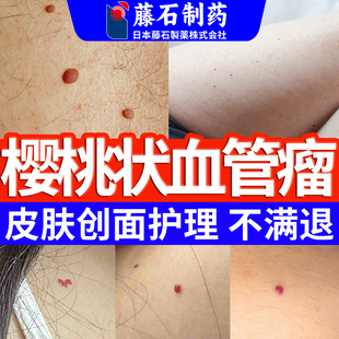 樱桃状血管瘤术后护理血管痣药监备案膏点红痣凝胶无痕正品去SE