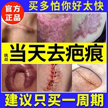 祛疤膏去疤痕增生凸起去除疙瘩修复膏日本除疤儿童瘢痕烫伤剖腹产