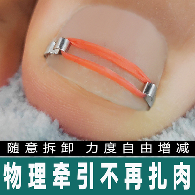 用创甲沟嵌甲正甲扣矫正器