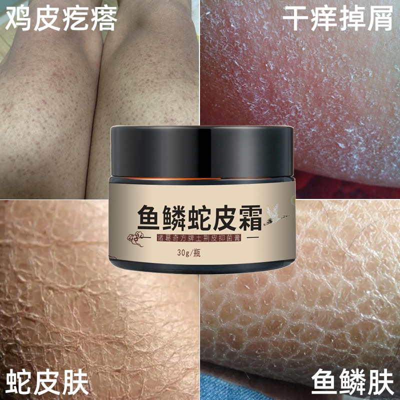 加强型去除鸡鱼鳞蛇皮肤干燥粗糙疙瘩毛囊角质化身体乳液鸡皮肤霜