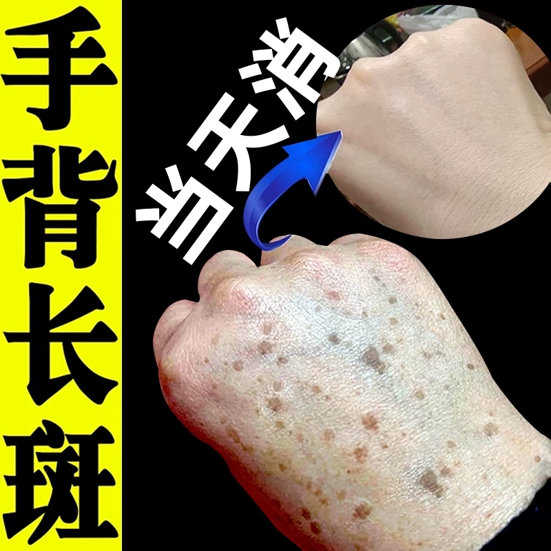 去老人斑专用药膏一擦就掉除老年黑班强力一抹净手脸部黄褐祛斑霜