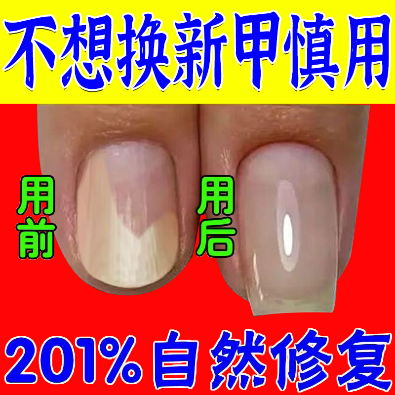 【最近很火的】嚴(yán)重灰甲甲溝炎足部護(hù)理同仁堂搽劑脫甲止痛止癢液