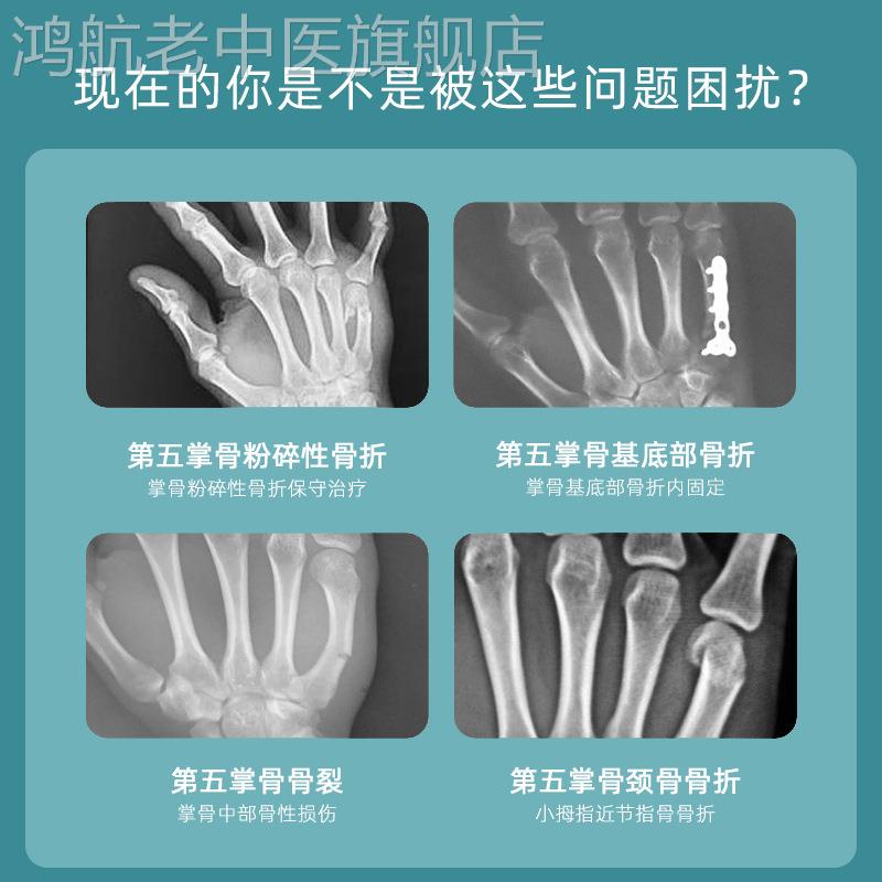 护腕拇指骨折固定支具第五掌骨手指护指套手掌小拇指手腕夹板护具