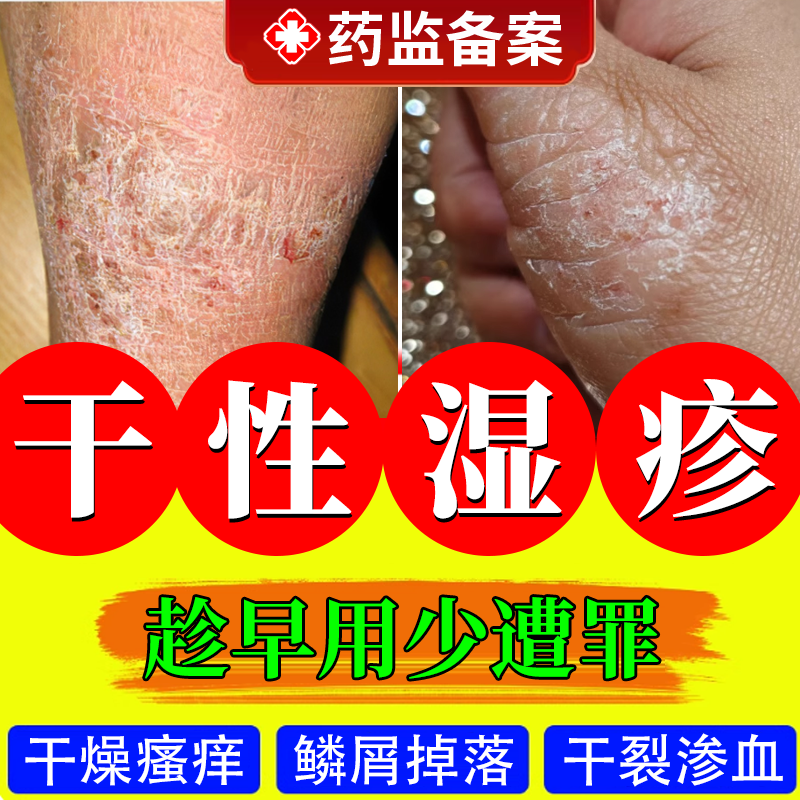 干性湿疹 干燥瘙痒