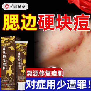 淋巴痘腮边痘专用结节药房膏红肿硬块非痘痘贴消炎脸上祛石头痘YS