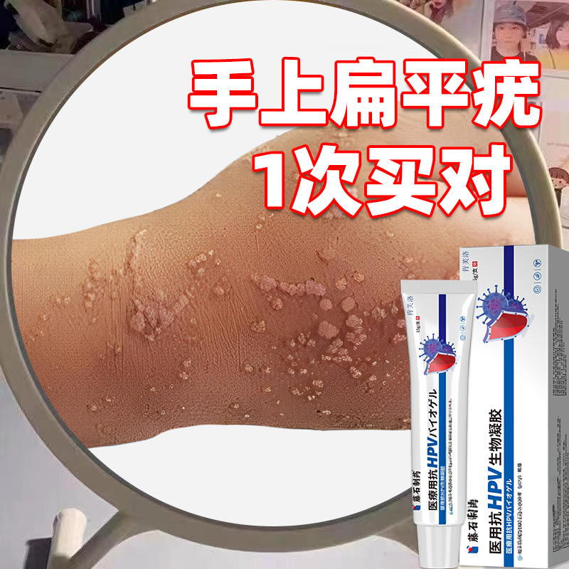 点痣点扁平疣水祛疣瘊子尤去脖子上的小肉粒神器去除膏一抹灵YS