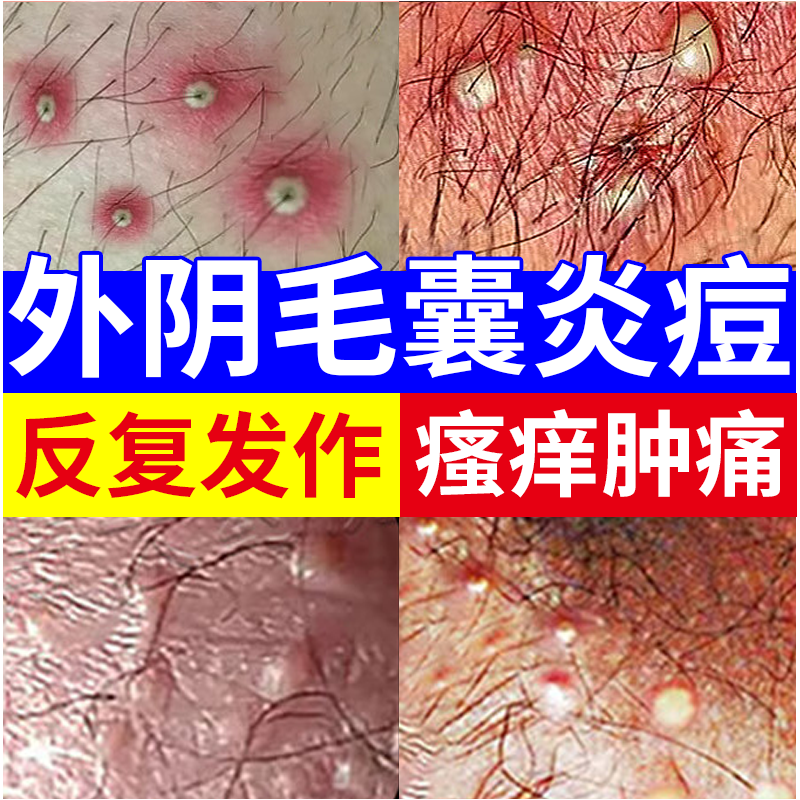 外阴毛囊炎硬疙瘩瘙痒有小疙瘩专用搭治疗下体阴毛痒私处药膏用ys