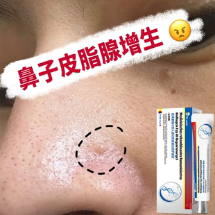 鼻子皮脂腺增生软膏鼻头鼻翼上肉疙瘩异位症去药房膏酒糟鼻面部YS