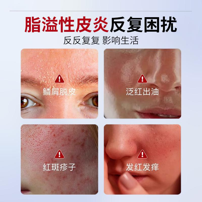 鼻翼鼻子两侧脂溢性皮炎发红脱皮泛红面部软膏马拉色菌面霜脸部YS