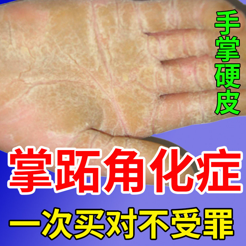掌跖角化症手掌心发黄增厚硬皮角化型专用膏蜕皮干裂掌趾外用ym