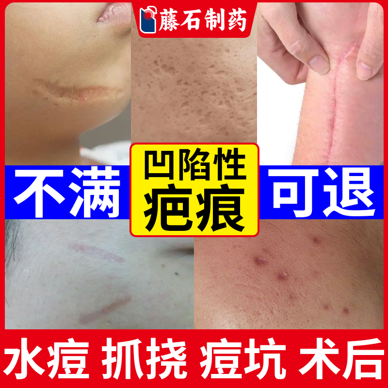 【现货速发】专注凹陷性疤痕