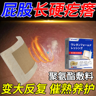 屁股上长火疖子敷料贴药房同款膏贴疖肿拔毒痘痘皮下硬疙瘩YM