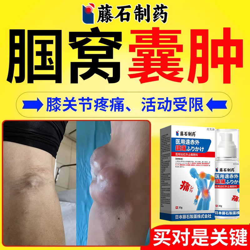 【药监认证】腘窝囊肿关节疼痛
