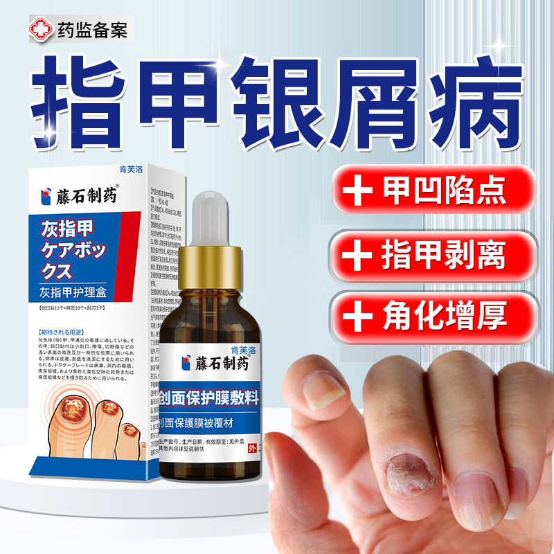 银屑病甲指甲真菌感染剥离发黄增厚凹凸不平修复液药房同款YM
