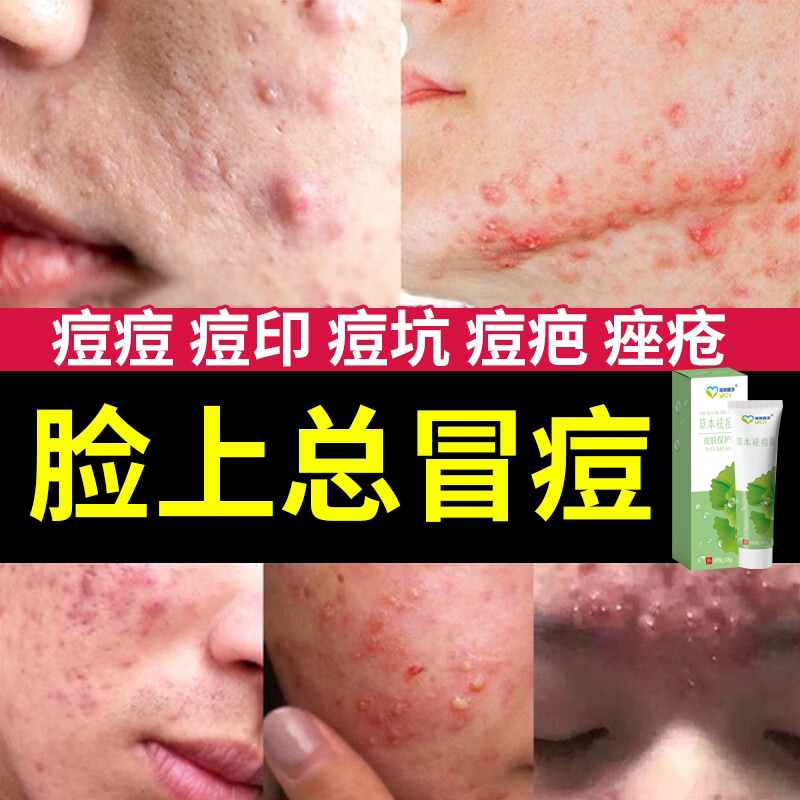 痘痘修复消炎医用祛痘印淡化却去痘印痘坑痘疤豆豆贴药房同款膏ys