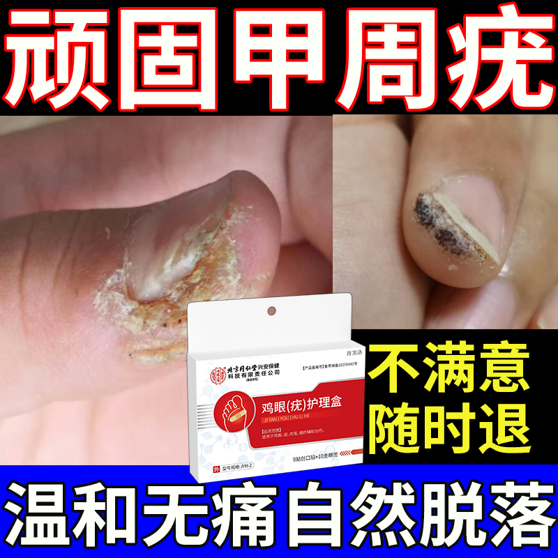 【速发】手上甲周疣无痛自然脱落