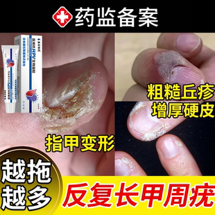 甲周疣专用去手指长疣儿童手上甲下疣软化硬皮寻常疣药房同款膏YS