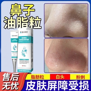 去鼻子油脂粒脂肪粒去除神器凝胶软膏鼻头可搭去除粟丘疹用YS